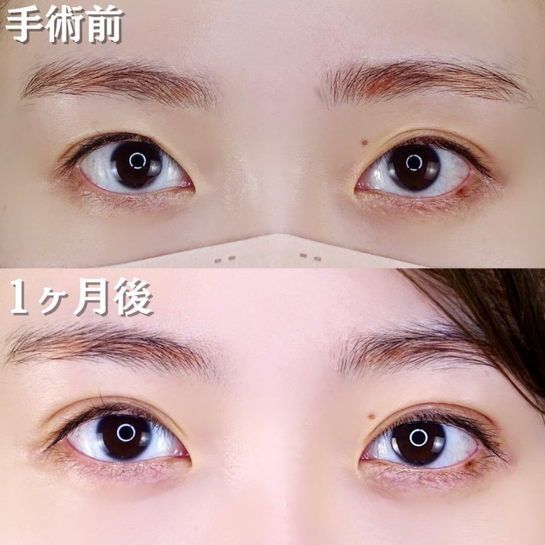 二重埋没法(担当医:TCB 医師)の症例写真1