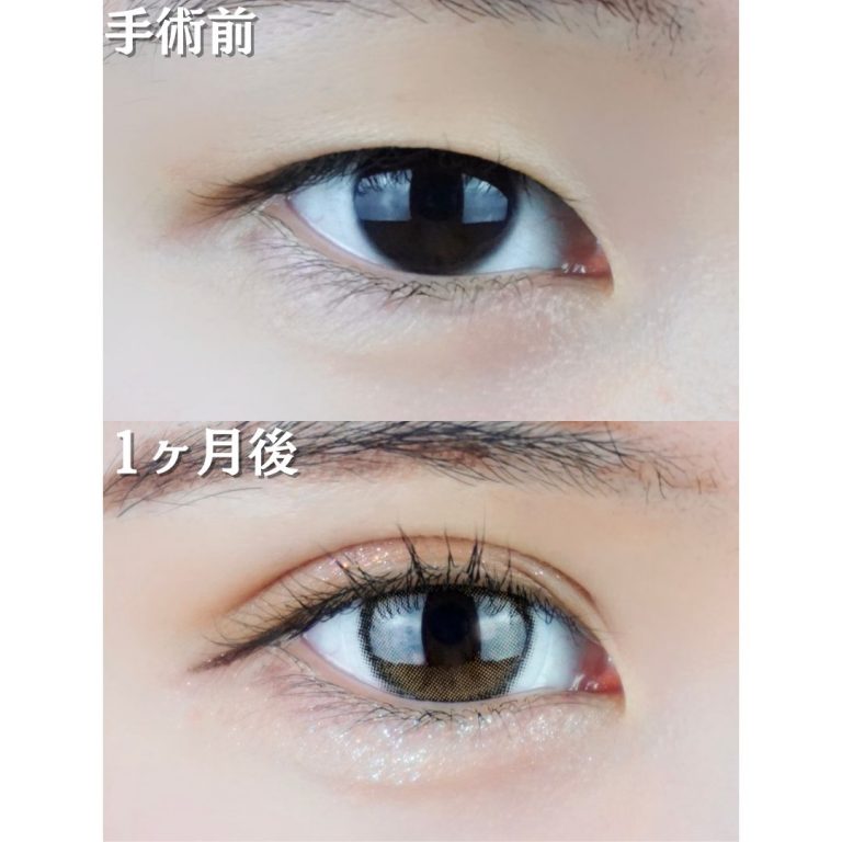 二重埋没法(担当医:TCB 医師)の症例写真1