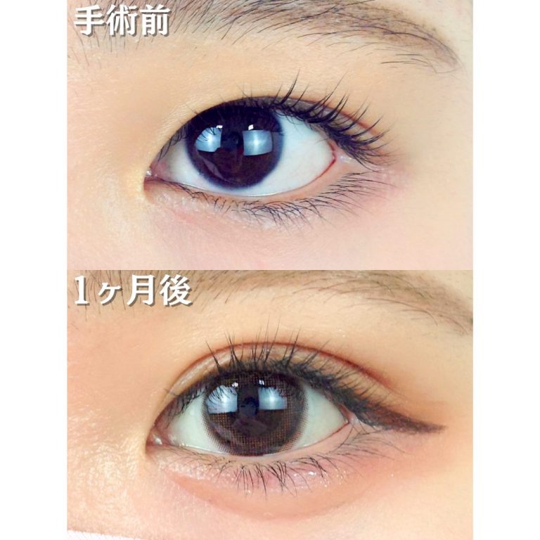 二重埋没法(担当医:TCB 医師)の症例写真1