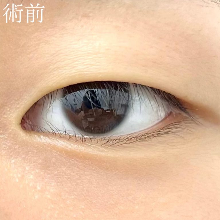 二重埋没法(担当医:TCB 医師)の症例写真2