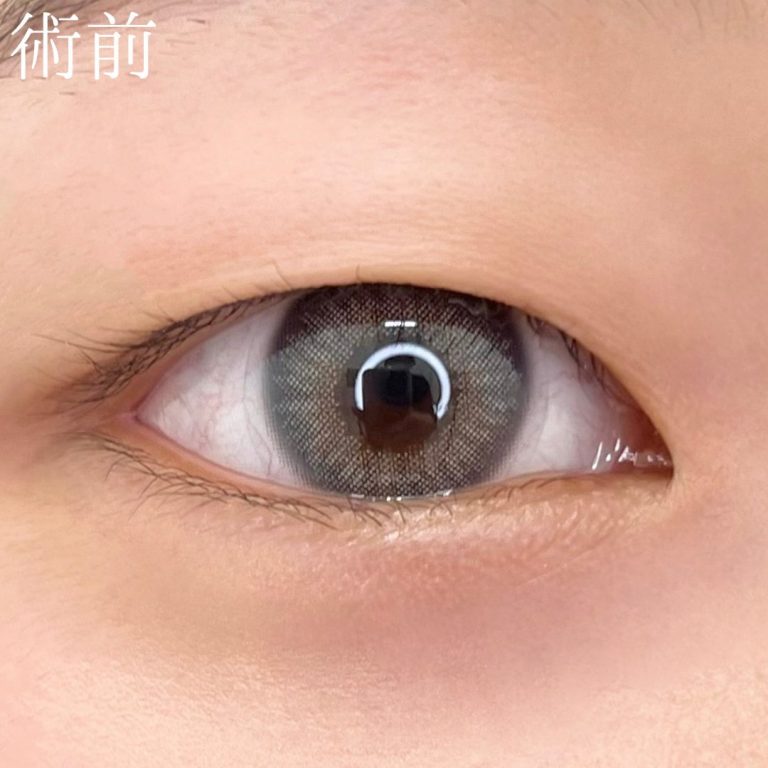 二重埋没法(担当医:TCB 医師)の症例写真2