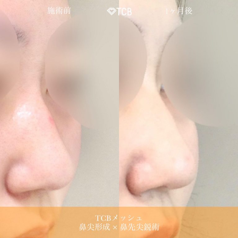 鼻尖形成(担当医:佐藤 麻未 医師)の症例写真3