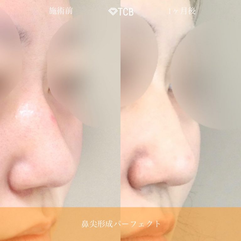 鼻尖形成完全閉鎖法（切らない鼻尖形成）(担当医:佐藤 麻未 医師)の症例写真2