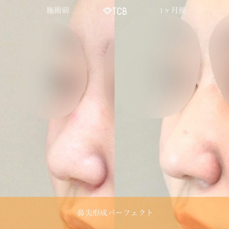 鼻尖形成完全閉鎖法（切らない鼻尖形成）(担当医:佐藤 麻未 医師)の症例写真3