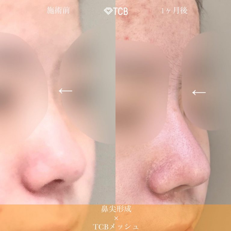 鼻尖形成(担当医:佐藤 麻未 医師)の症例写真2