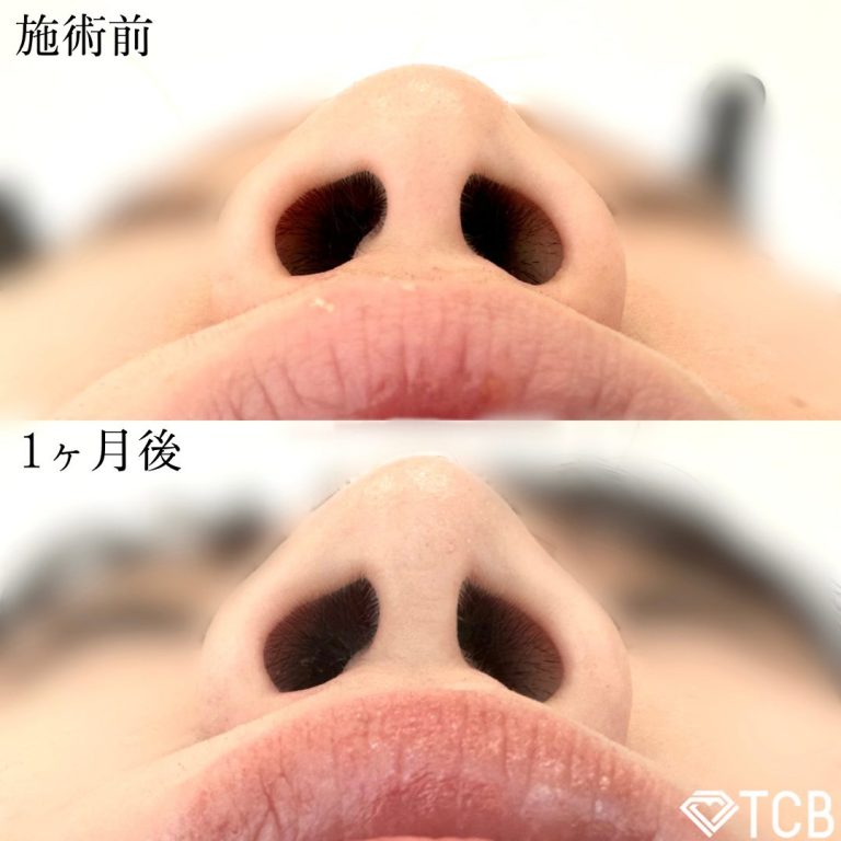 鼻尖形成完全閉鎖法（切らない鼻尖形成）(担当医:TCB 医師)の症例写真2