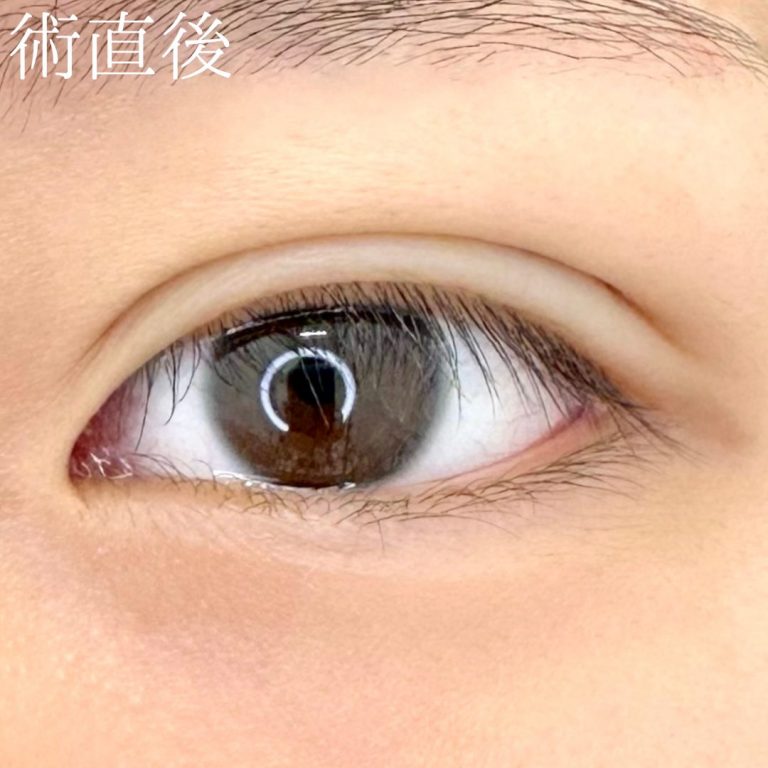 二重埋没法(担当医:TCB 医師)の症例写真3