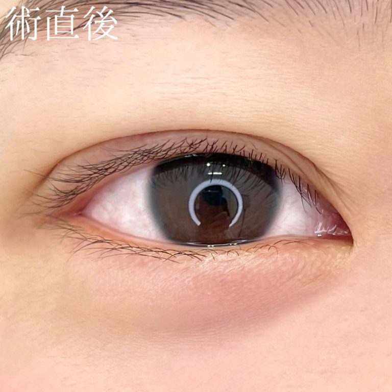 二重埋没法(担当医:TCB 医師)の症例写真3