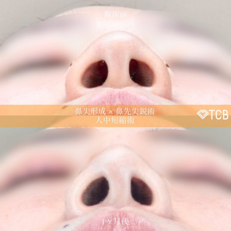 鼻プロテーゼ（隆鼻術）(担当医:佐藤 麻未 医師)の症例写真1
