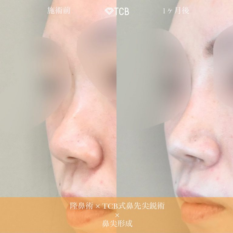 鼻プロテーゼ（隆鼻術）(担当医:佐藤 麻未 医師)の症例写真2