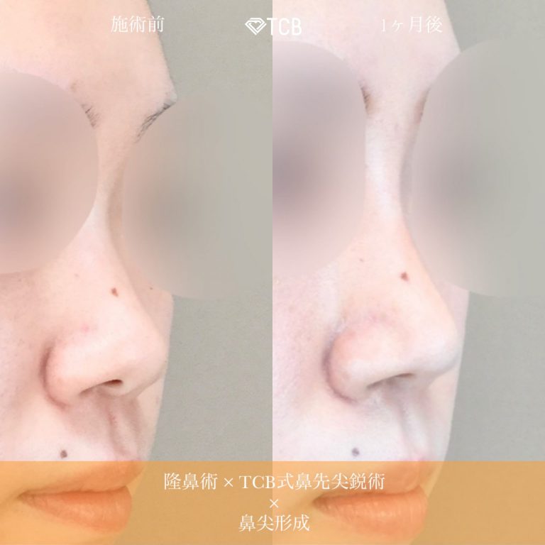 鼻プロテーゼ（隆鼻術）(担当医:佐藤 麻未 医師)の症例写真3