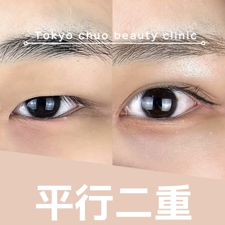 二重埋没法(担当医:TCB 医師)の症例写真3