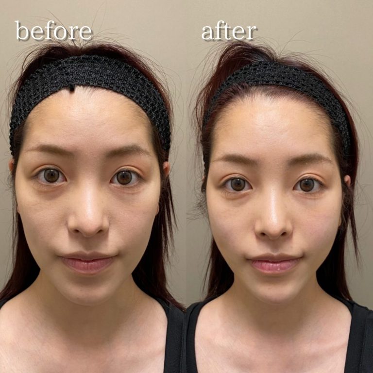 小顔美肌再生（リフトアップ）(担当医:TCB 医師)の症例写真1
