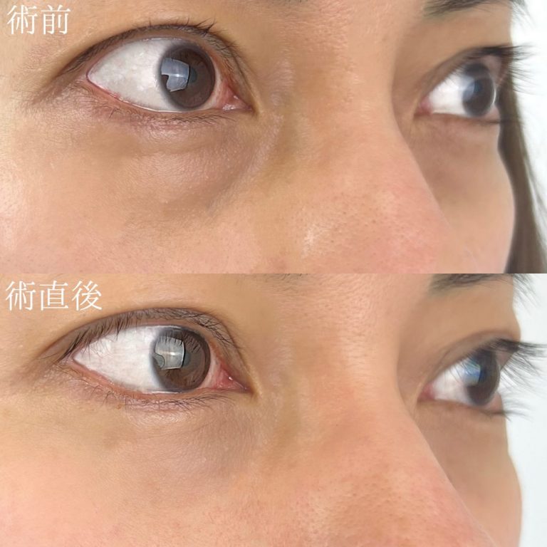 切らない目の下のクマ取り・目の下のたるみ（ふくらみ）取り(担当医:TCB 医師)の症例写真4
