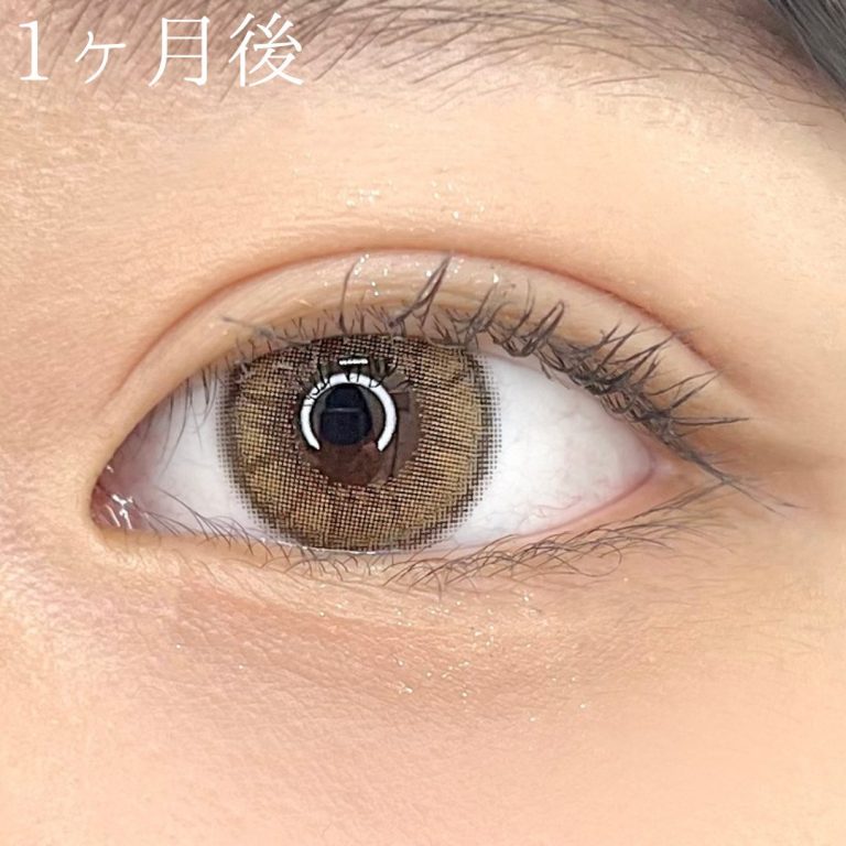 二重埋没法(担当医:TCB 医師)の症例写真4