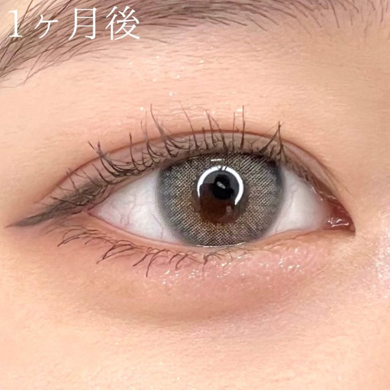 二重埋没法(担当医:TCB 医師)の症例写真4