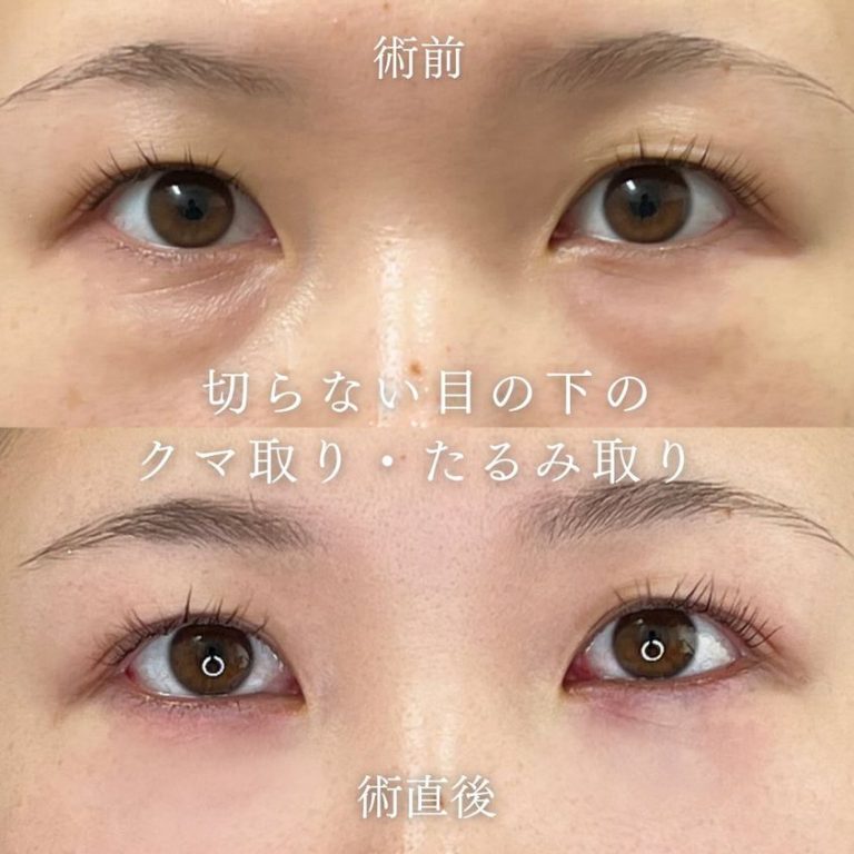 切らない目の下のクマ取り・目の下のたるみ（ふくらみ）取り(担当医:TCB 医師)の症例写真1