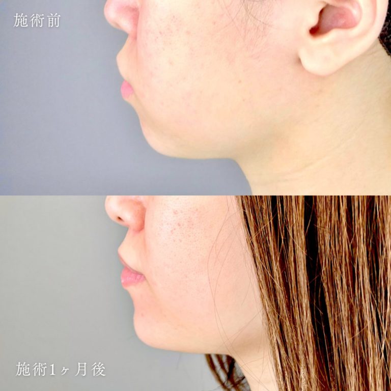 切らない顎形成 3D Eライン(担当医:河村 宜生 医師)の症例写真2