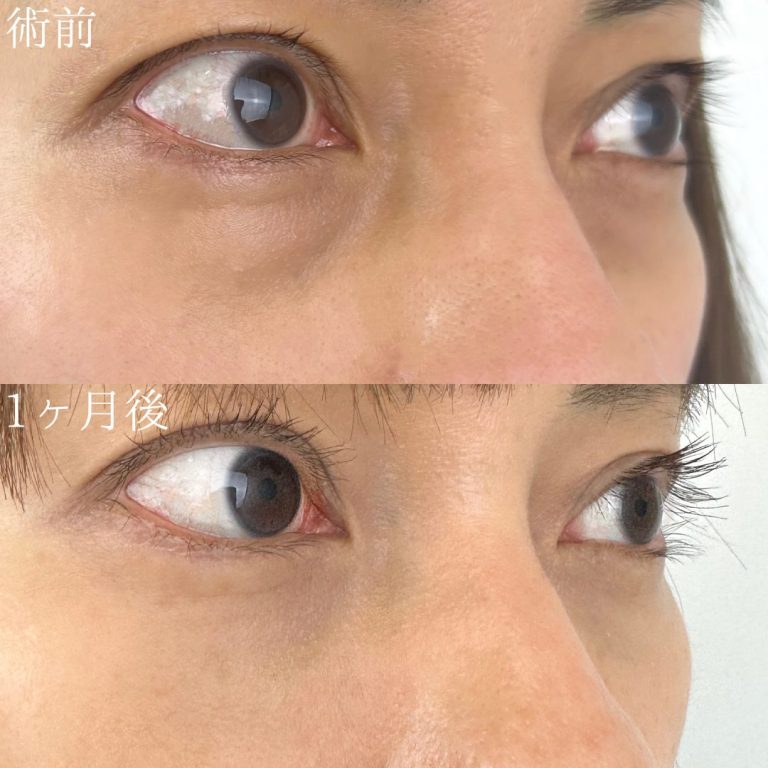 切らない目の下のクマ取り・目の下のたるみ（ふくらみ）取り(担当医:TCB 医師)の症例写真3