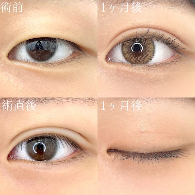 二重埋没法(担当医:TCB 医師)の症例写真1