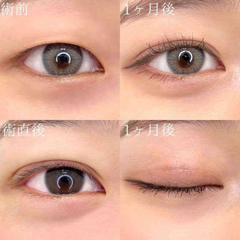 二重埋没法(担当医:TCB 医師)の症例写真1