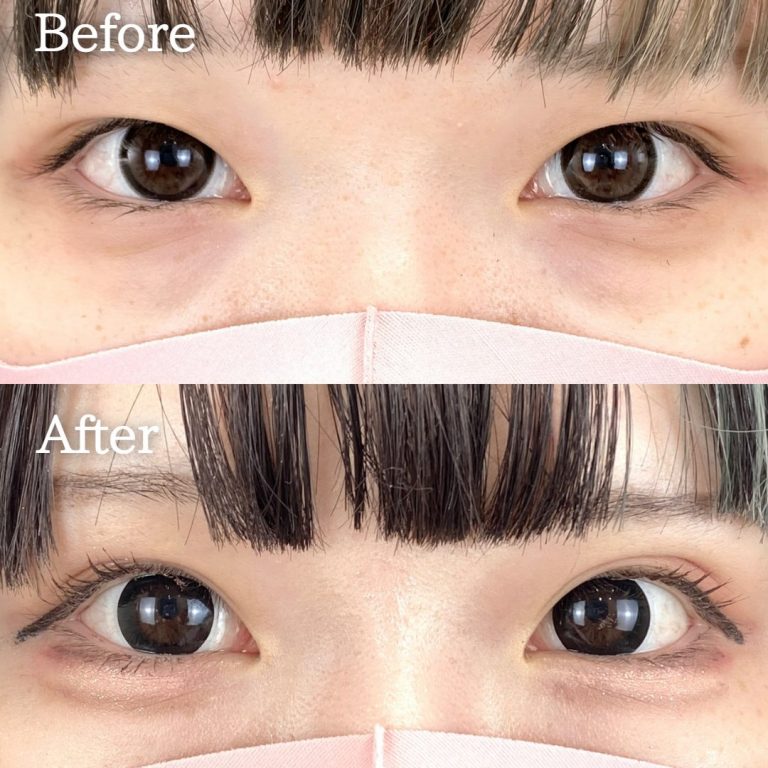 二重埋没法(担当医:TCB 医師)の症例写真1