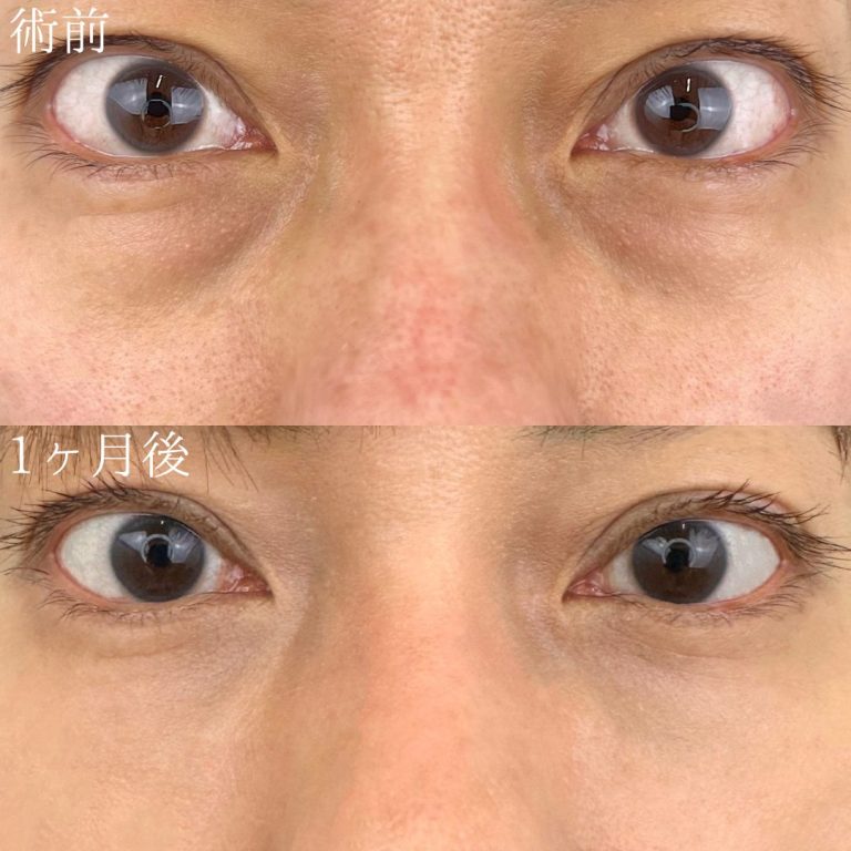 切らない目の下のクマ取り・目の下のたるみ（ふくらみ）取り(担当医:TCB 医師)の症例写真1