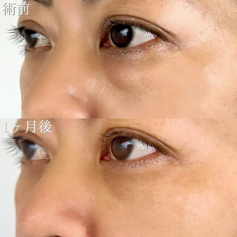 切らない目の下のクマ取り・目の下のたるみ（ふくらみ）取り(担当医:TCB 医師)の症例写真3