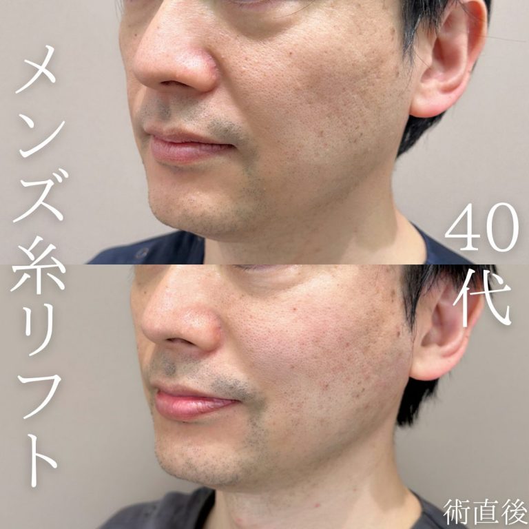 小顔美肌再生（リフトアップ）(担当医:TCB 医師)の症例写真1