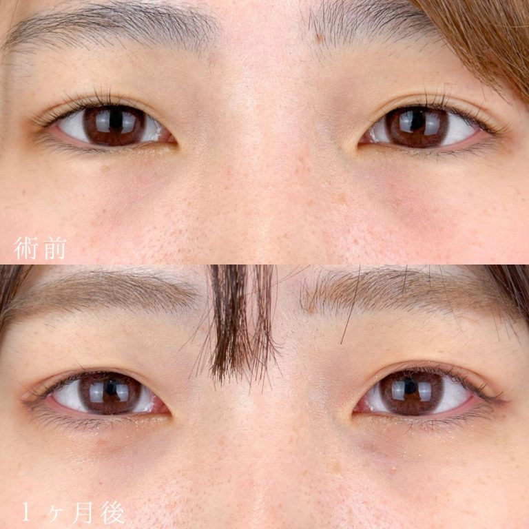 切らない目の下のクマ取り・目の下のたるみ（ふくらみ）取り(担当医:TCB 医師)の症例写真1