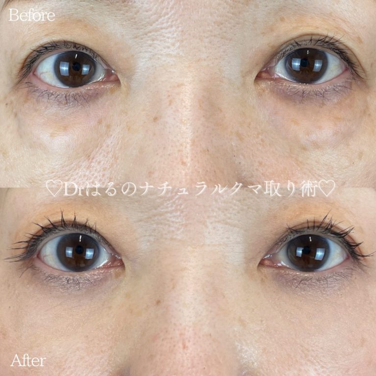 切らない目の下のクマ取り・目の下のたるみ（ふくらみ）取り(担当医:TCB 医師)の症例写真1