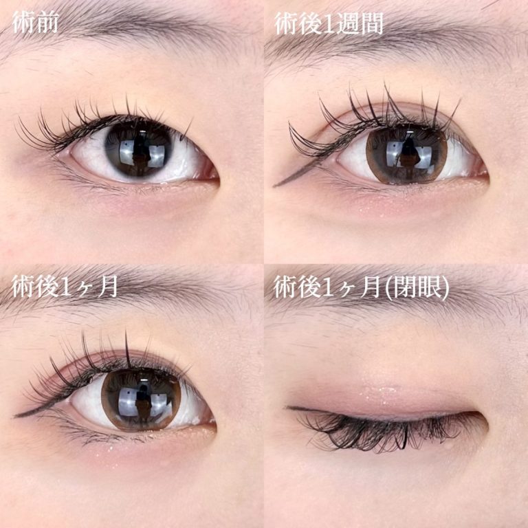 二重埋没法(担当医:TCB 医師)の症例写真1