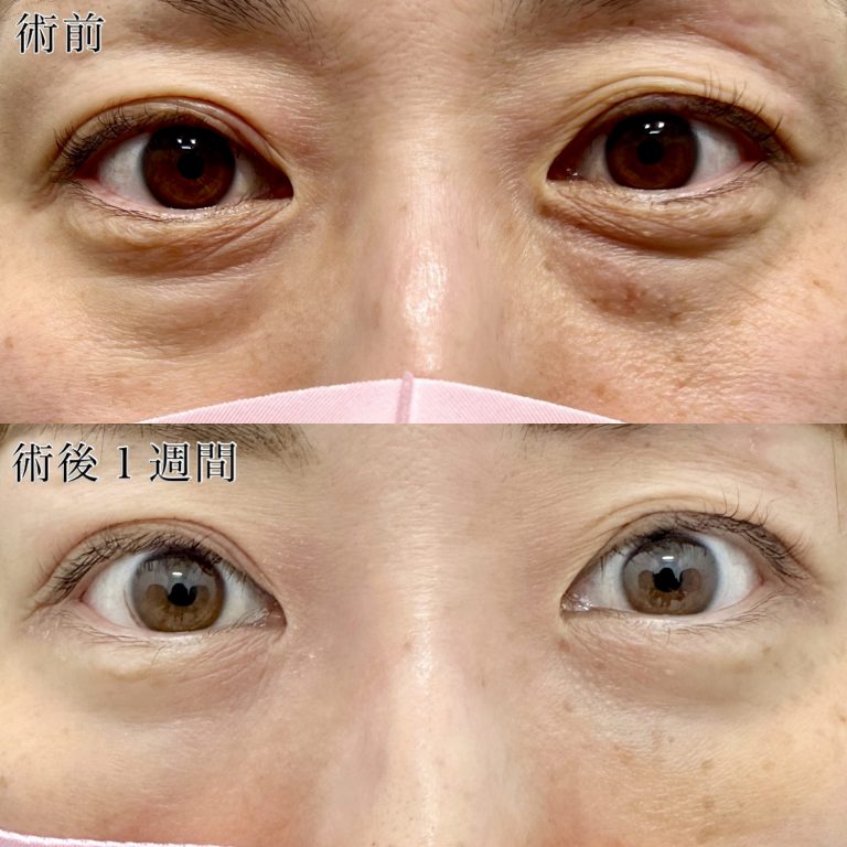切らない目の下のクマ取り・目の下のたるみ（ふくらみ）取り(担当医:TCB 医師)の症例写真1