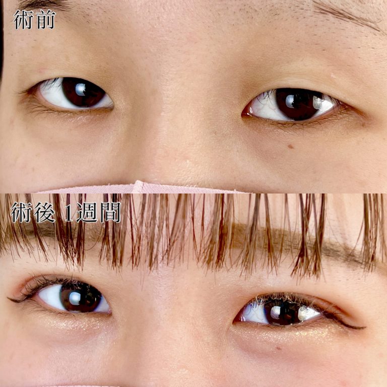 二重埋没法(担当医:長谷川 三那子 医師)の症例写真2