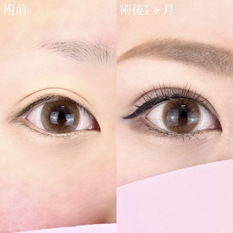二重埋没法(担当医:TCB 医師)の症例写真1