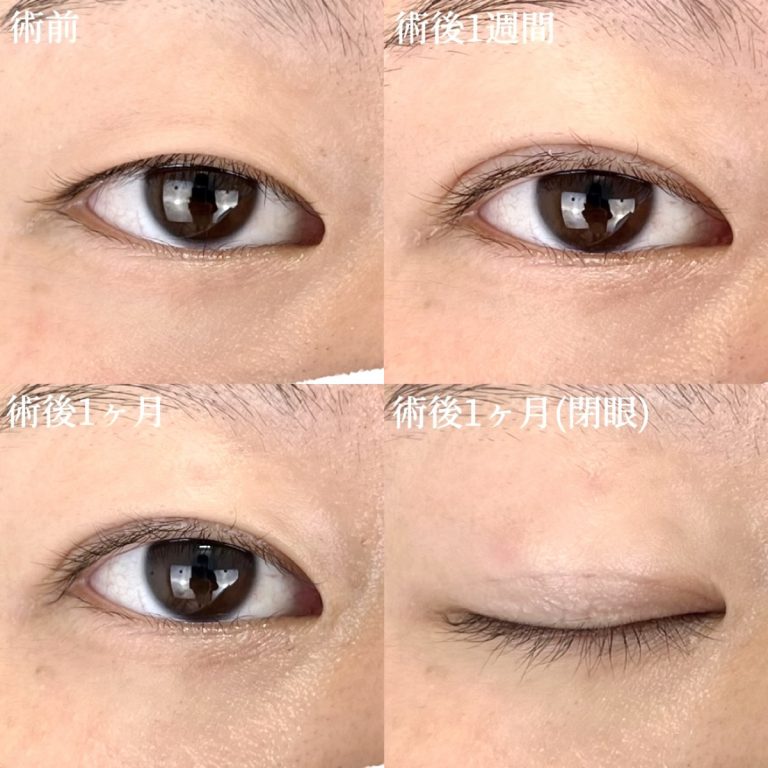 二重埋没法(担当医:TCB 医師)の症例写真1