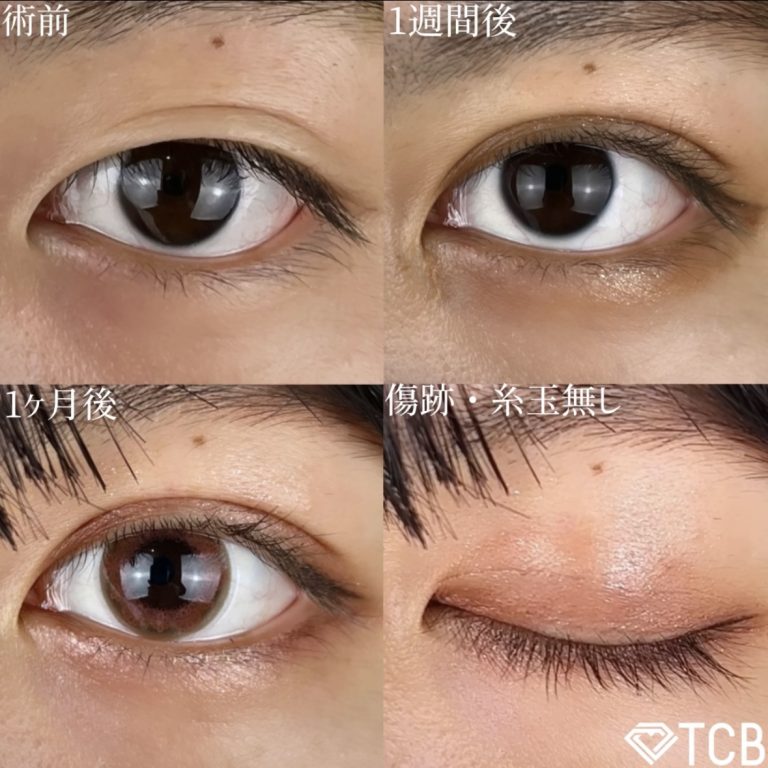 二重埋没法(担当医:TCB 医師)の症例写真1