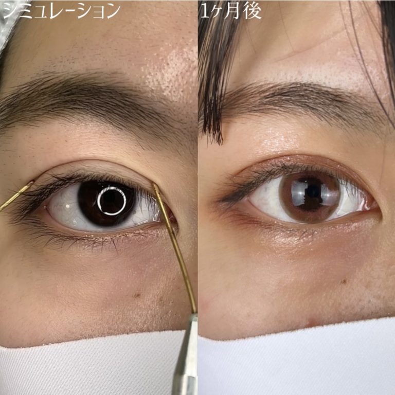 二重埋没法(担当医:TCB 医師)の症例写真3