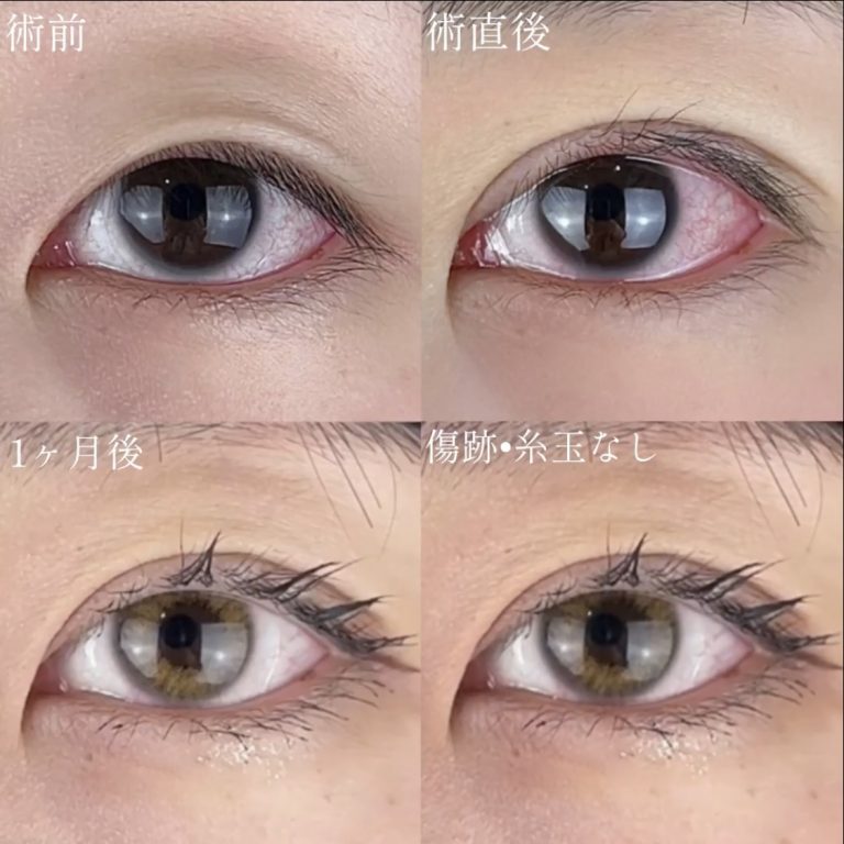 二重埋没法(担当医:TCB 医師)の症例写真1