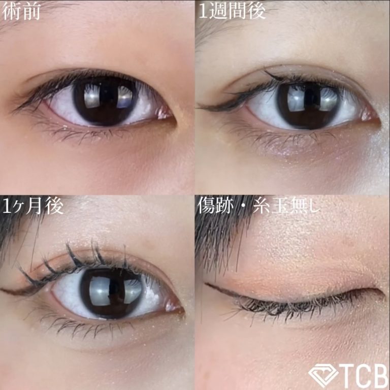 二重埋没法(担当医:TCB 医師)の症例写真1