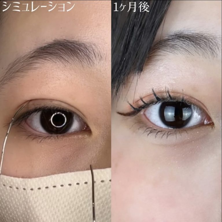 二重埋没法(担当医:TCB 医師)の症例写真2