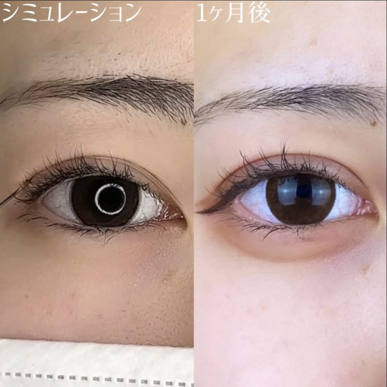 二重埋没法(担当医:TCB 医師)の症例写真3