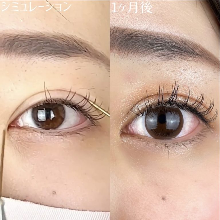 二重埋没法(担当医:TCB 医師)の症例写真3