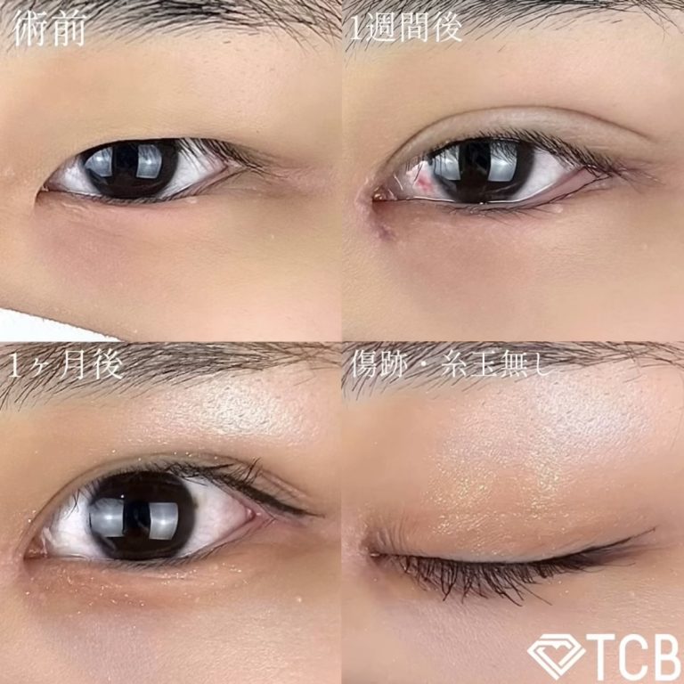 二重埋没法(担当医:TCB 医師)の症例写真1