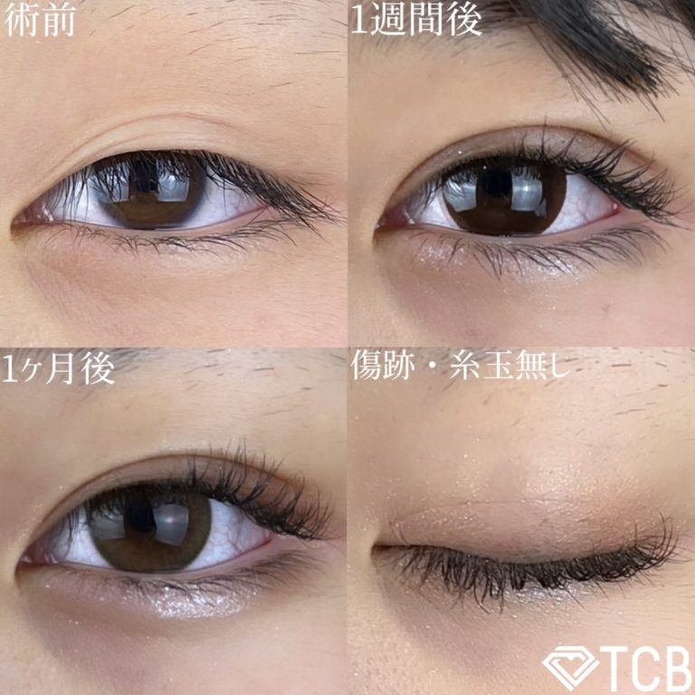 二重埋没法(担当医:TCB 医師)の症例写真2