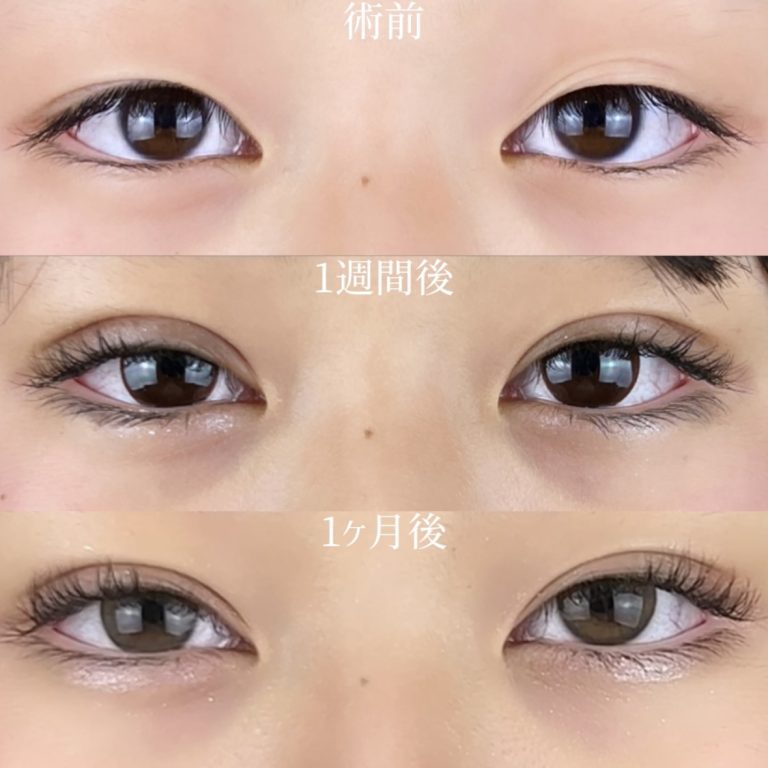 二重埋没法(担当医:TCB 医師)の症例写真1