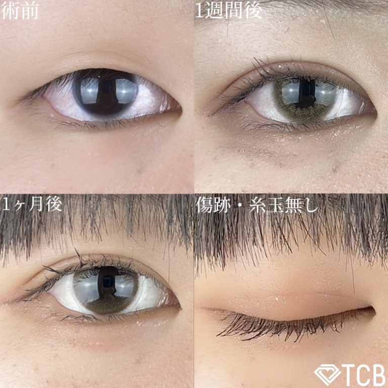 二重埋没法(担当医:TCB 医師)の症例写真2