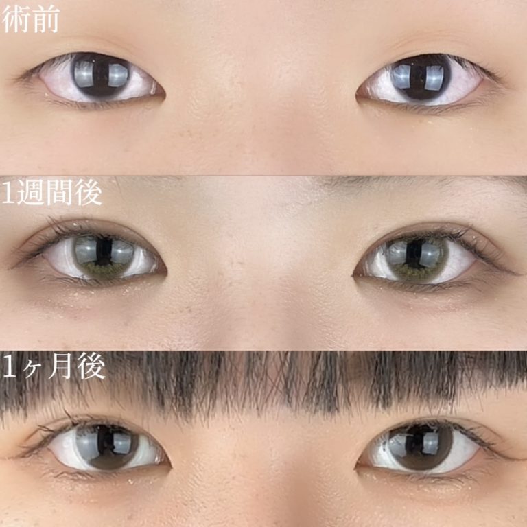 二重埋没法(担当医:TCB 医師)の症例写真1