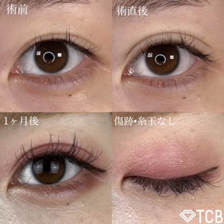 二重埋没法(担当医:TCB 医師)の症例写真1