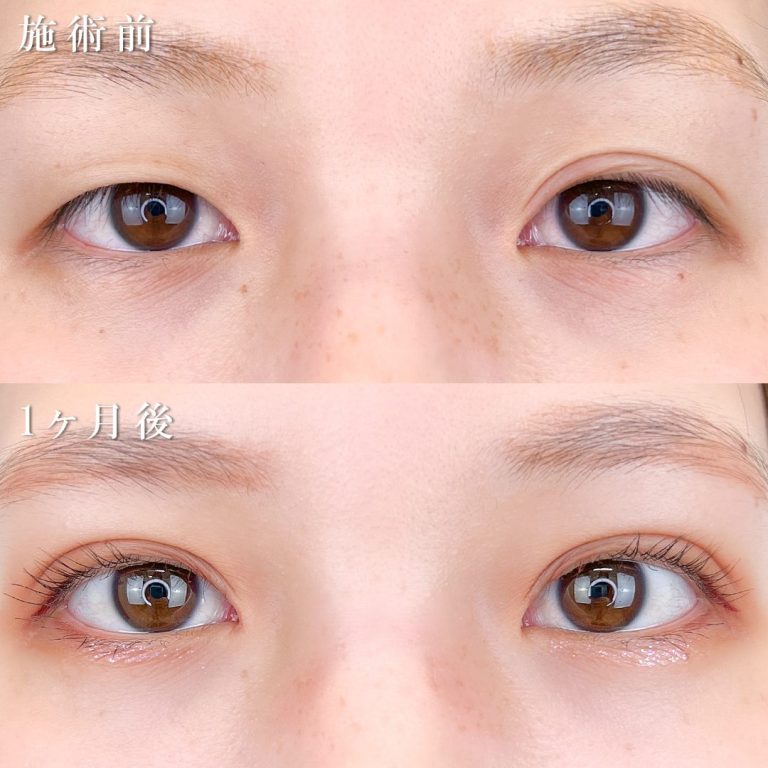 二重埋没法(担当医:TCB 医師)の症例写真1